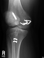 Anterior cruciate ligament screw